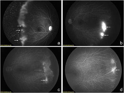 Different Types of Hyperfluorescence Observed in Post Anti-VEGF Fluorescein Angiographic Patterns in Retinopathy of Prematurity Patients